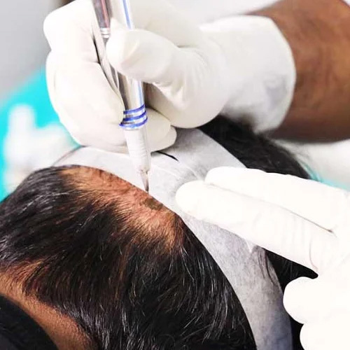 Scalp-Micropigmentation